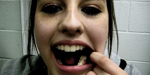 What Is The Best Way To Get Cavities Filled?