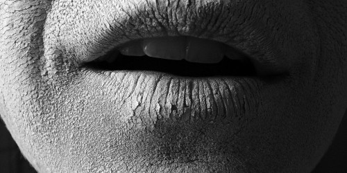 What Causes Dry Skin in Winter and How to Treat It?