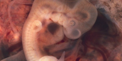 Signs And Symptoms Of An Ectopic Pregnancy