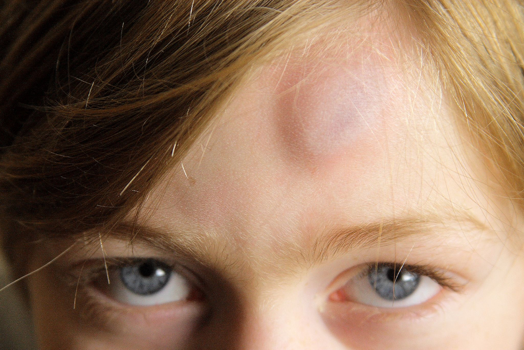 Bone Bruises: More Then Meet the Eye | Musculoskeletal Issues articles ...