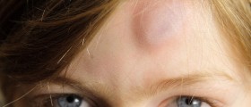 Bone Bruises: More Then Meet the Eye