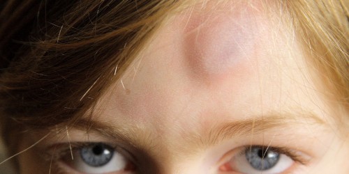 Bone Bruises: More Then Meet the Eye