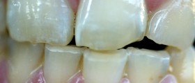 How To Make Your Gums Lighter?