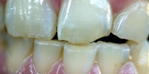 How To Make Your Gums Lighter?