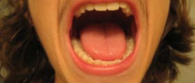 What Is That White Patch Inside Your Mouth?