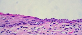 What Is An Incompetent Cervix During Pregnancy?