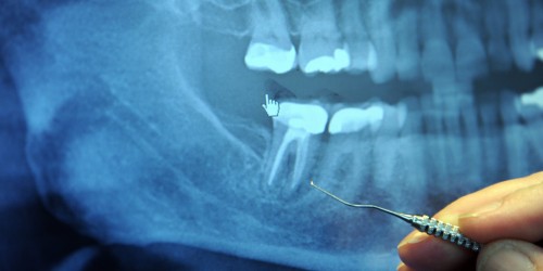 Why Do Some Root Canal Treatments Fail Over Time?