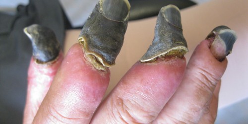 Sepsis, The Disease That Won't Go Away