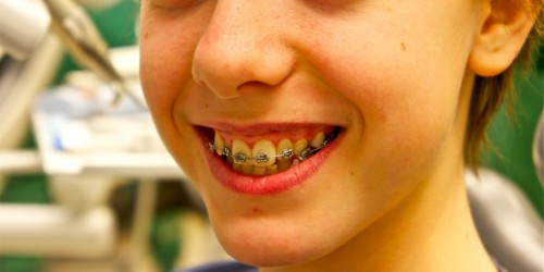 Why Do Teeth Become Crooked After Orthodontic Treatment? How Can It Be Prevented?