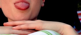 Hairy Tongue, Geographic Tongue, And Other Common Tongue Malformations