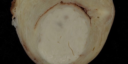 Uterine fibroids during pregnancy