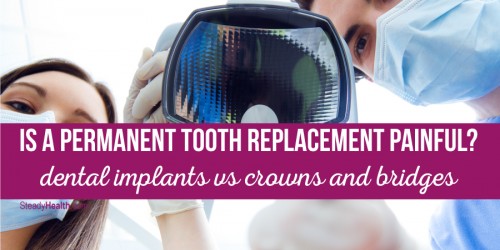 Is A Permanent Tooth Replacement Painful? Dental Implants vs Crowns And Bridges