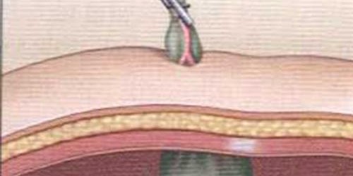 What your doctor forgot to tell you about gallbladder removal