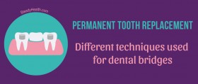 Permanent Tooth Replacement: Different Techniques Used For Dental Bridges