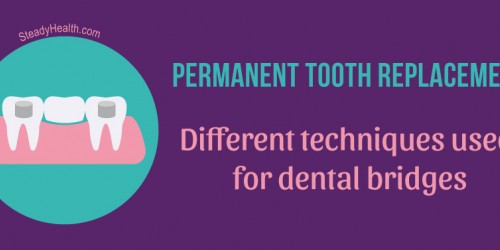 Permanent Tooth Replacement: Different Techniques Used For Dental Bridges