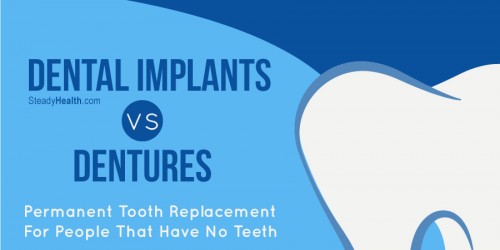 Permanent Tooth Replacement For People That Have No Teeth: Dental Implants vs Dentures