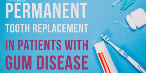 Permanent Tooth Replacement In Patients With Gum Disease