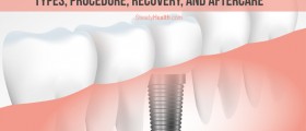 Permanent Tooth Replacement With Dental Implants: Types, Procedure, Recovery, And Aftercare