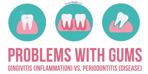 Problems With Gums: Gingivitis (Gum Inflammation) vs. Periodontitis (Gum Disease)