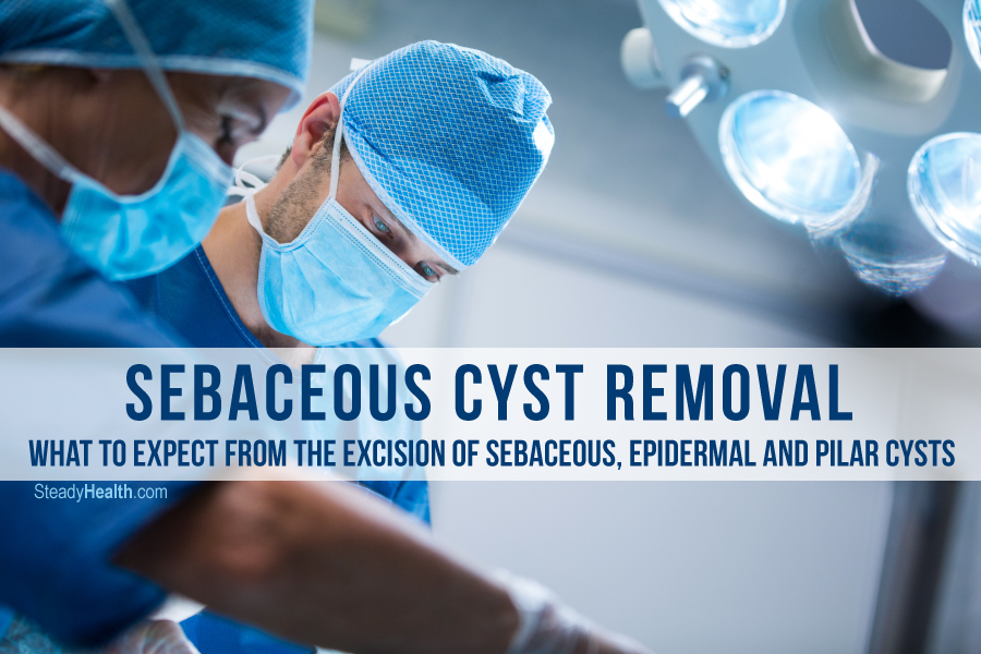 sebaceous-cyst-removal-what-to-expect-from-the-excision-of-sebaceous