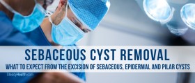 Sebaceous Cyst Removal: What To Expect From The Excision Of Sebaceous, Epidermal And Pilar Cysts