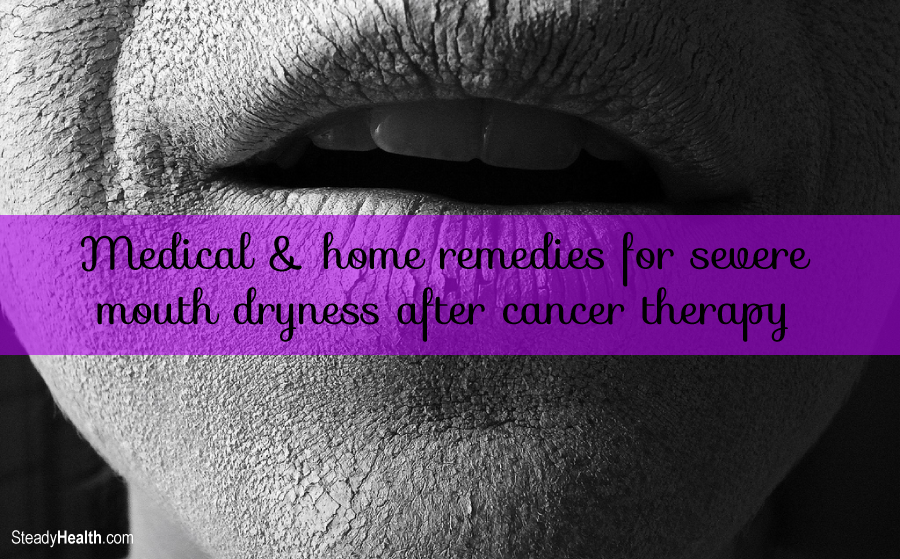 Severe Mouth Dryness After Cancer Therapy Medical and Home Remedies Cancer articles Body