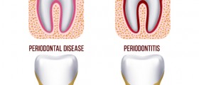 Signs of Gum Disease: Gingivitis vs Periodontitis vs Advanced Periodontitis