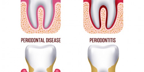 Signs of Gum Disease: Gingivitis vs Periodontitis vs Advanced Periodontitis