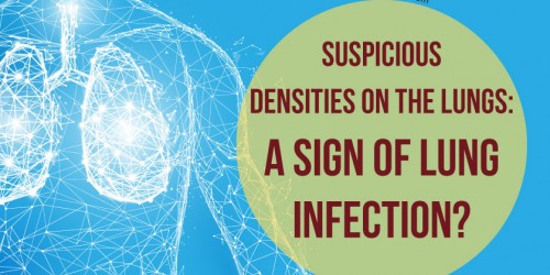 Suspicious Densities On The Lungs: A Sign Of Lung Infection?