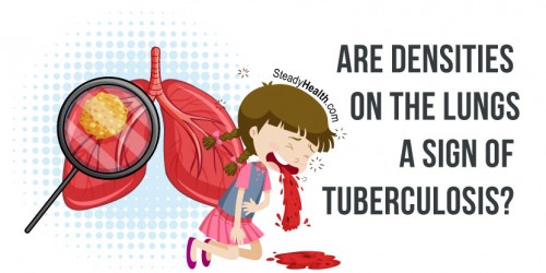 Suspicious Densities On The Lungs: A Sign Of Tuberculosis (TB)?