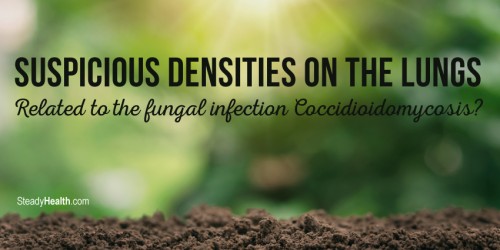 Suspicious Densities On The Lungs: Related To The Fungal Infection Coccidioidomycosis?