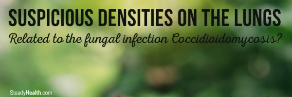 Suspicious Densities On The Lungs: Related To The Fungal Infection Coccidioidomycosis?