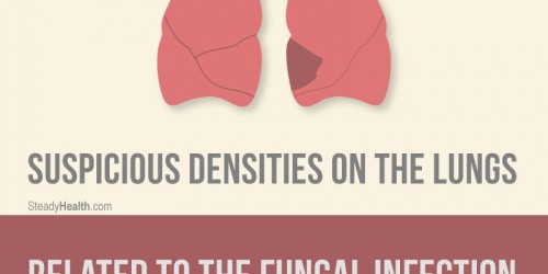 Suspicious Densities On The Lungs: Related To The Fungal Infection Histoplasmosis?