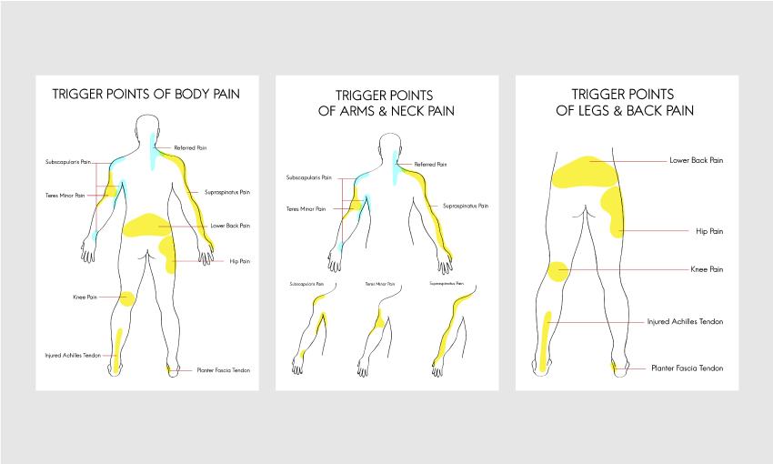 Tender Points (Fibromyalgia) vs Trigger Points (Myofascial Pain