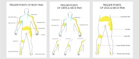 Tender Points (Fibromyalgia) vs Trigger Points (Myofascial Pain Syndrome)