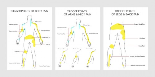 Tender Points (Fibromyalgia) vs Trigger Points (Myofascial Pain Syndrome)