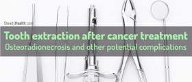 Tooth extraction after cancer treatment: Osteoradionecrosis and other potential complications