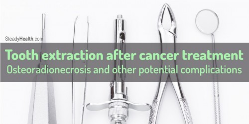 Tooth extraction after cancer treatment: Osteoradionecrosis and other potential complications