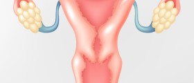 What Every Woman With Endometriosis Should Know About Ovarian Cancer