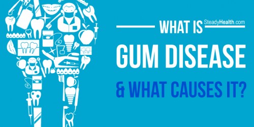 What Is Gum Disease And What Causes It?