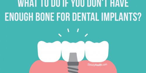 What To Do If You Don't Have Enough Bone For Dental Implants?