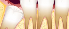 Wisdom Tooth Problems: Do You Need Your Impacted Wisdom Teeth Removed?