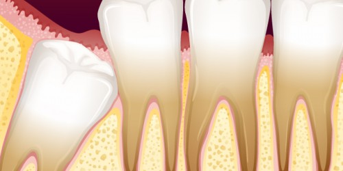 Wisdom Tooth Problems: Do You Need Your Impacted Wisdom Teeth Removed?