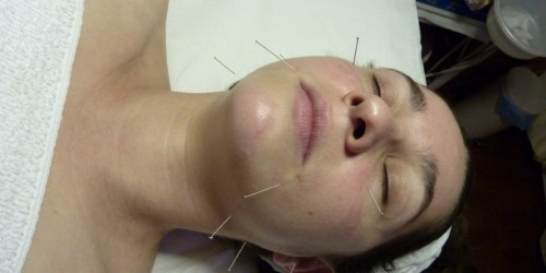 Berkley Acupuncture Method To Prevent Miscarriage