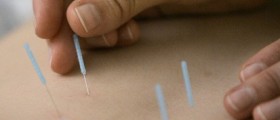 Chinese Medicine, Health and Wellness-Acupuncture