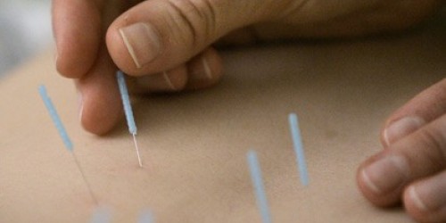 Chinese Medicine, Health and Wellness-Acupuncture