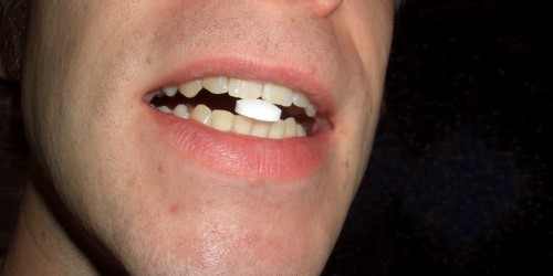 Anti-Inflammatory Drugs for Depression: Can an Aspirin a Day Keep The Blues Away?