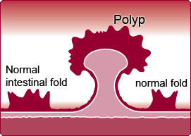 Are Colorectal Polyps Cancerous? | Cancer articles | Body & Health ...