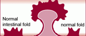 Are Colorectal Polyps Cancerous?