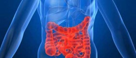 Crohn's disease- chronic inflammation of the digestive tract